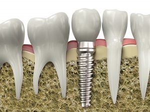 dental implants napier