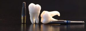 dental implants napier