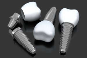 dental implants napier