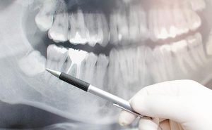 surgical procedures wisdom teeth removal